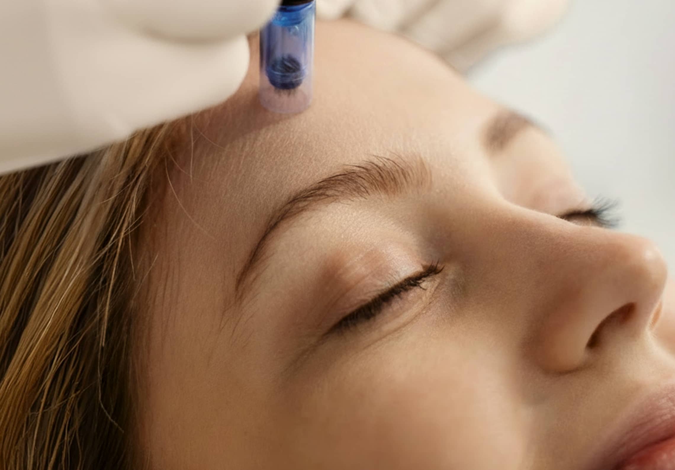 microneedling